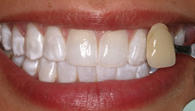 Cosmetic Whitening Better After