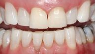Cosmetic Whitening Better After