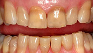 Yellow Teeth Before